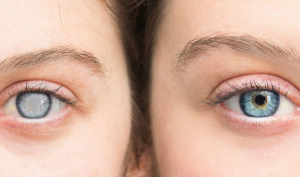 gazi-hastanesi-katarakt