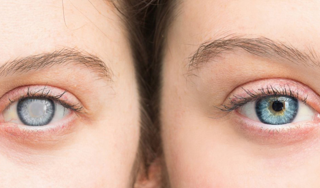 gazi-hastanesi-katarakt