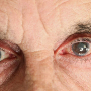 kataraktın nedenleri