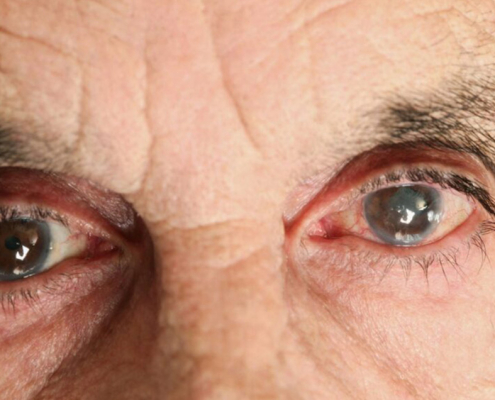 kataraktın nedenleri