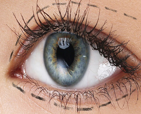 Oküloplastik Cerrahi