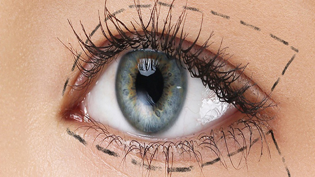 Oküloplastik Cerrahi