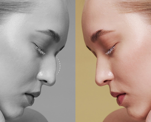 gazi-hastanesi-burun-estetiği