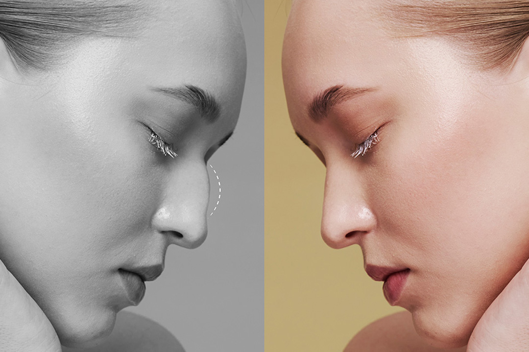 gazi-hastanesi-burun-estetiği