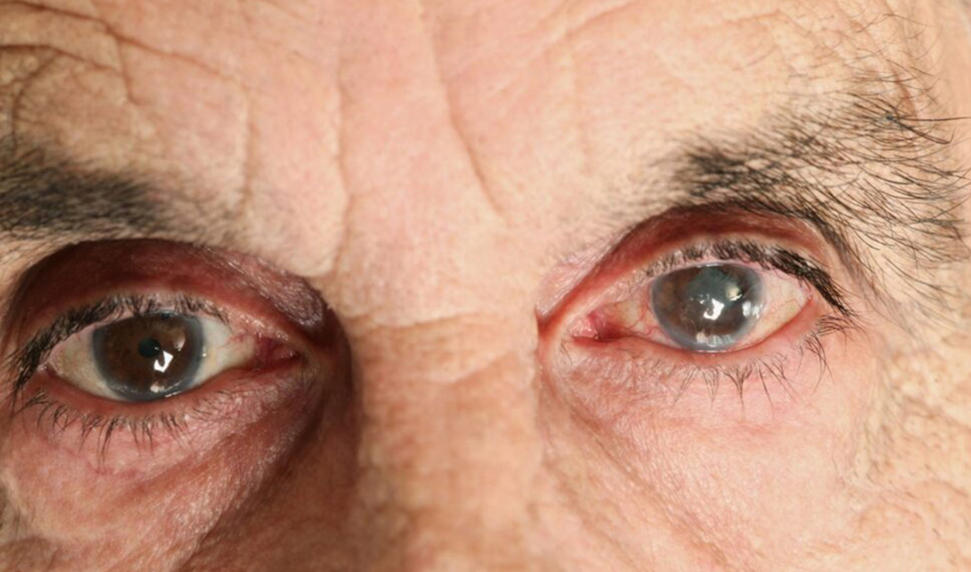 kataraktın nedenleri