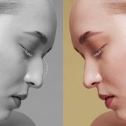 Burun Estetiği (Rinoplasti)