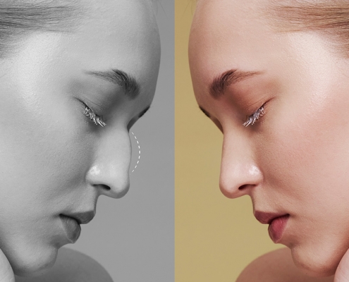 Burun Estetiği (Rinoplasti)