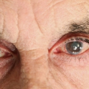 Kataraktın Nedenleri