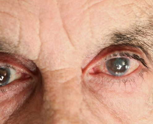 Kataraktın Nedenleri